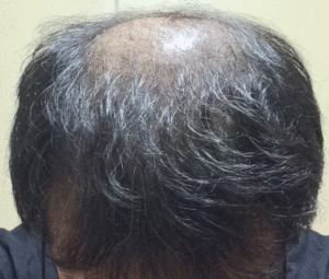 頭皮を鮮明にしたミノタブ再開と初期脱毛からの回復経過
