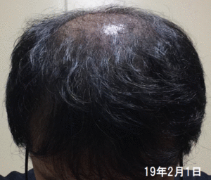 ミノタブ初期脱毛からの回復と経過